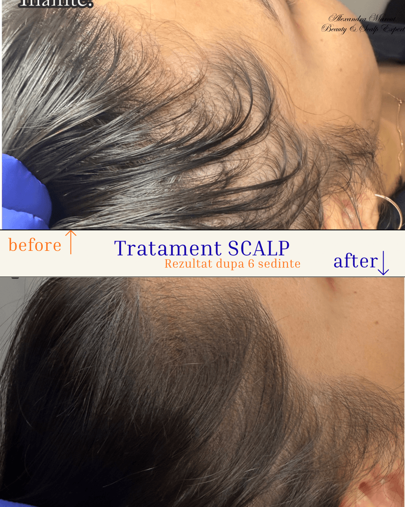 Tratament_scalp2.png
