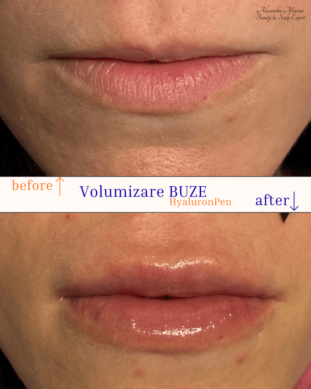 Hyaluron Pen Treatment 1