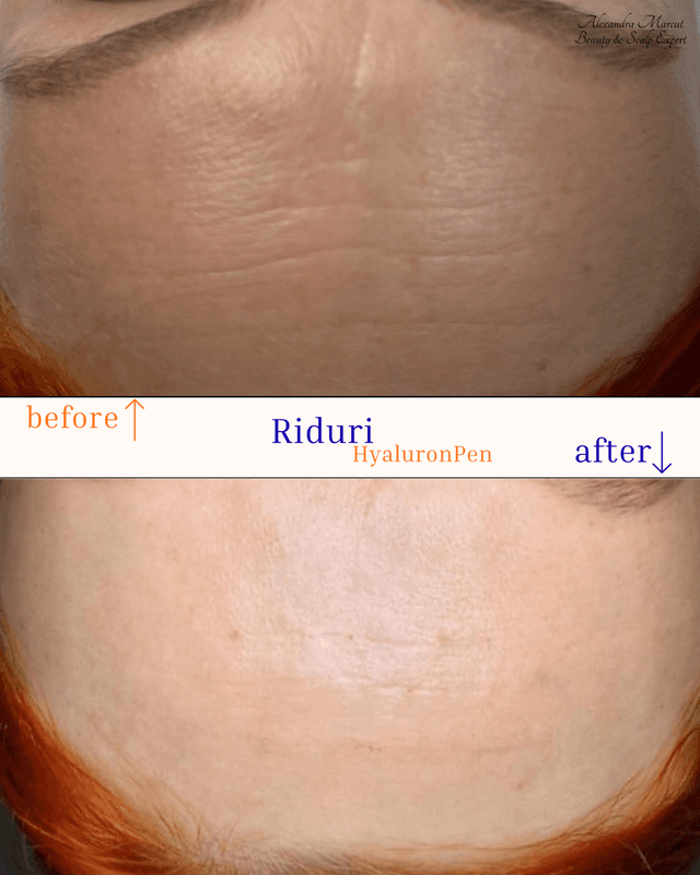 Hyaluron Pen Treatment 2
