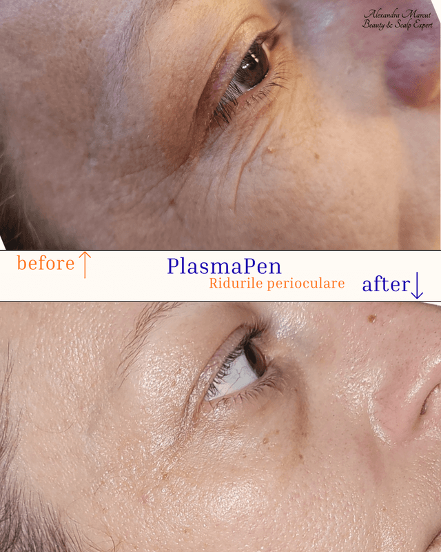 Plasma Pen Treatment 2