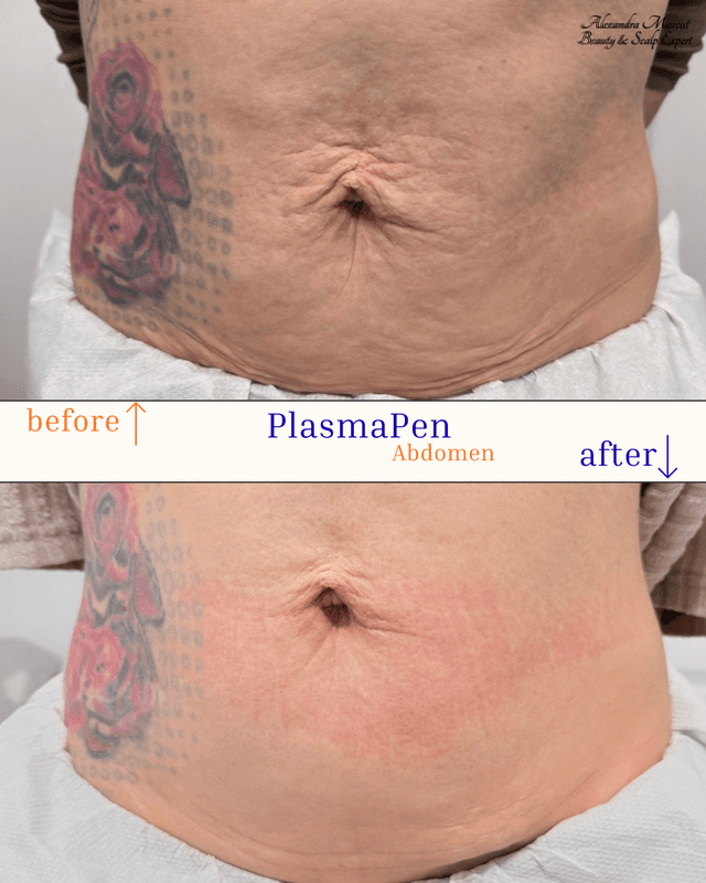 Plasma Pen Treatment 1